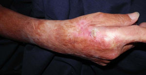 Hyperkeratotic lesions on the right hand.