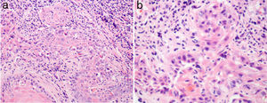 Pathological exam. Well-differentiated squamous cell carcinoma, 200× (a) and 400× (b).