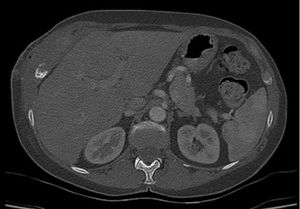 Chest and abdominal CT scan shows bone destruction (12th rib).
