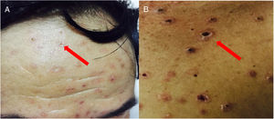 Disseminated histoplasmosis with molluscum-like lesions on face (A) and chest (B).