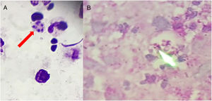 Giemsa stain (A) from skin fluid and PAS-stain (B) from cutaneous biopsy showing both intracellular yeasts consistent with Histoplasmacapsulatum (100×).