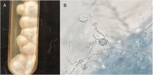 Histoplasma capsulatum culture on SDA at 25°C after 12 days (A) and micromorphology of the isolate showing tuberculate microconidias (B) (cotton blue preparation, 400×).