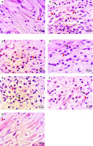 Representative photomicrographs of histological analyses of vaginal mucosa sections after different treatments: (A) non-infected animals (negative control) – vaginal mucosa with normal aspect; (B) infected and untreated animals – presence of inflammatory infiltrate in the lamina propria; (C) Infected animals treated with ethanol solution – presence of inflammatory infiltrate in the mucosa with polymorphonuclear infiltration mainly; (D) infected animals treated with MCZ (positive control) – presence of inflammatory process with polymorphonuclear infiltration mainly; (E) Infected animals treated with 0.25% curcumin – inflammatory infiltrate in the vaginal mucosa with polymorphonuclear infiltration mainly; (F) infected animals treated with 0.5% curcumin – inflammatory infiltrate in the vaginal mucosa, with polymorphonuclear infiltration mainly; (G) infected animals treated with 1% curcumin – reduction in mucosal inflammatory infiltrate compared to 0.25% and 0.5% curcumin treatments. The black arrows point to polymorphonuclear leucocytes. The red arrows point to mononuclear leucocytes. H&E stain, 400× magnification.