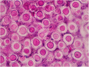 Numerous encapsulated cells of C. neoformans in the smear from a subcutaneous nodule sample of a dog with cryptococcosis. PAS stain.