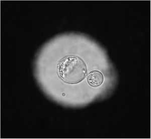 Negative stain of a smear showing an encapsulated budding yeast cell of C. neoformans. A fine needle aspiration was taken from a lymph node of a cat with cryptococcosis. The cat was infected with feline immunodeficiency virus. India ink stain.