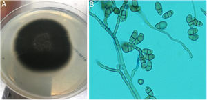 A) Aspecto del hongo en Sabouraud-cloranfenicol tras 7 días de incubación. B) Tinción de azul de lactofenol donde se observan los conidios curvados.