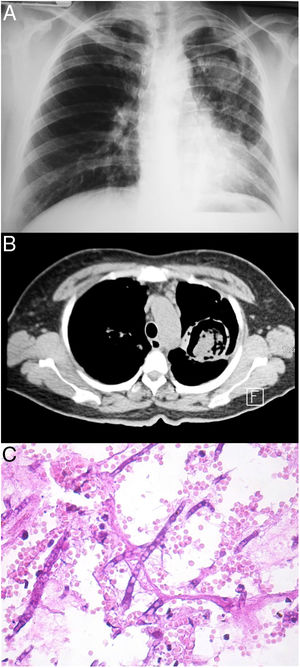 Hallazgos radiológicos y patológicos de un caso de infección por Aspergillus fumigatus. a) Radiografía de tórax con el signo de media luna localizado en la región intercleidohiliar izquierda. b) Tomografía simple de tórax con el signo del halo clásico en el aspergiloma. c) Corte histológico de pulmón con tinción PAS; se observan hifas septadas que forman ángulos de 45° (40×).