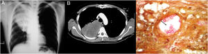 Hallazgos radiológicos y patológicos de un caso de infección por Cryptococcus neoformans. a) Radiografía de tórax con opacidad homogénea de bordes mal definidos, localizada en la región intercleidohiliar y parahiliar derecha. b) Tomografía simple de tórax con imagen hiperdensa en lóbulo medio de pulmón derecho. c) Corte histológico de pulmón con tinción de hierro coloidal; se observan estructuras esféricas en bicapa en relación con un vaso sanguíneo (40×).