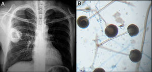 Hallazgos radiológicos y patológicos de un caso de infección por Rhizopus oryzae. a) Radiografía de tórax con opacidad heterogénea de bordes definidos en región hiliar derecha. b) Corte histológico de pulmón con tinción azul de algodón; pueden observarse rizoides, filamentos y esporangios.