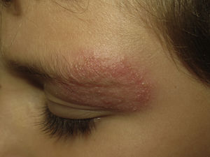 Annular plaque on left eyebrow with pustules on the active edge.