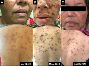 Disseminated sporotrichosis in an HIV patient. A. Erythematous papules and pustules appeared after 14 days of active antiretroviral treatment (ART) – before the diagnosis of sporotrichosis (April 2019). B. Skin lesions evolution, showing ulcers and crusts. Sporotrichosis was confirmed and amphotericin B deoxycholate treatment was prescribed (May 2019). C. Regression of lesions after 77 days of itraconazole (August 2019).