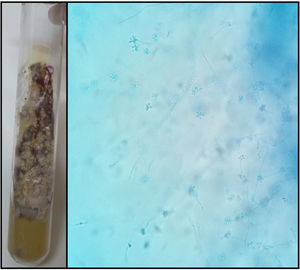 Culture of Sporothrix brasiliensis (Sabouraud dextrose agar, 7 days at 30°C) isolated from the skin biopsy.