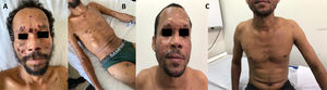 Cutaneous lesions outcome before and after treatment. (A, B) Crusting lesions on the face and tumours in lower right hemithorax, right cervical chain and ribs before treatment. (C) Skin lesions on the face and thorax after treatment.