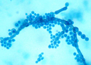 Smear of an old culture showing septate, brown hyphae, conidiophores and phialides without collarettes. Conidia are pale brown, one-celled, and round to oval in shape; they gather in balls at the apices of the phialides and down the side of the conidiophore.