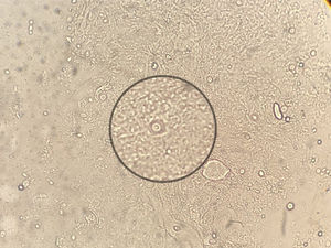Wet mount microscopic observation of the ulcer scraping (200×).