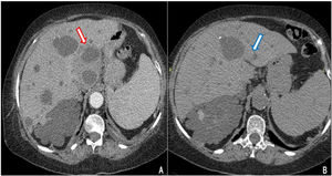 Contrast-enhanced abdominal CT. (A) Multiple cystic images in liver and kidney parenchyma. Liver segment I has a cystic image with edema and peripheral contrast enhancement (red arrow). (B) Resolution of the abscess in liver segment I after antibiotic and antifungal treatment (blue arrow).
