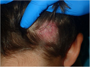 Swelling and patchy alopecia on the occipital area.