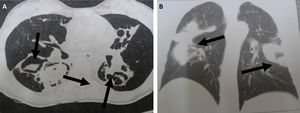 Chest CT scans of patients diagnosed with pulmonary mycoses. (A) Aspergillosis: CT section revealing bilateral lesions with cavities containing material with soft-tissue density and surrounding air, forming the air crescent sign (arrows); (B) Cryptococcosis: CT section showing bilateral parenchymal opacities with a pseudo-tumor aspect (arrows).