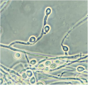 Scedosporium apiospermum (Scedosporium synanamorph). Obovoidal conidia can be seen on several anellated conidiogenous cells which are not swollen at their base. Phase-contrast microscopy.