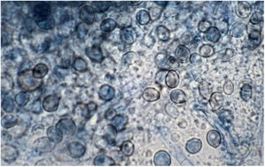 Lactophenol cotton blue stain of a smear from the nasal biopsy material from a dog with scedosporiosis2 showing numerous obovoidal conidia and hyphae.