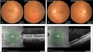 Images 5 days after diagnosing the ocular involvement in the woman with disseminated candidiasis. A – Right eye retinography: multiple, small, round, yellow-white lesions with indistinct borders limited to the posterior pole, one of them in the parafoveal region (arrows). Equatorial Roth spot (white asterisk). B – Spectral Domain Optical Coherence Tomography of the right eye: mild vitritis (yellow arrow) and parafoveal chorioretinal lesion which does not affect the outer retina (red asterisk). C – Left eye retinography: multiple, small, round, yellow-white lesions with indistinct borders in the posterior pole and equatorial retina (arrows). Roth spot hemorrhage (white asterisk). D – Spectral Domain Optical Coherence Tomography of the left eye: mild vitritis (yellow arrow) and preserved foveal profile.