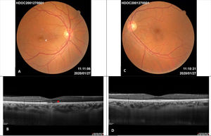 Images one year after diagnosis. A – Right eye retinography: residual white focal parafoveal scar (white arrow), complete disappearance of the lesions. B –Enhanced depth imaging optical coherence tomography of the right eye: subfoveal disruption in the external limiting membrane, ellipsoid zone and interdigitation zone with retinal pigment epithelium integrity (red asterisk). C – Left eye retinography: normal. D – Enhanced depth imaging optical coherence tomography of the left eye: normal.