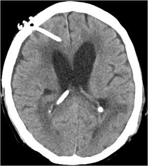 CT brain scan showing hydrocephalus and extra-ventricular drain in situ.