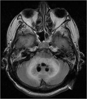 Axial T2 MR image showing evidence of active hydrocephalus with periventricular lucency. Abnormal hypointense lining was seen at the occipital horn corresponding to the enhancement in the post contrast scans.