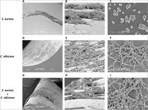 Analysis by SEM of the biofilm formed by S. aureus and/or C. albicans in a catheter model. (A, B and C) S. aureus monomicrobial biofilm at 700×, 5000×, and 5000×. (D, E and F) C. albicans monomicrobial biofilm at 250×, 2000×, and 2000×. (G, H and I) C. albicans and S. aureus polymicrobial biofilm at 250×, 5000×, and 2000×. This experiment was repeated twice in triplicate.