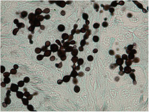 Histological section of a cutaneous lesion from a bottlenose dolphin with lobomycosis showing the characteristic yeast cells in chains. Grocott stain. Photo courtesy of Professor Leonel Mendoza, Michigan State University, USA.