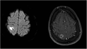 Post contrast brain MRI with T1W and DWI imaging. The lesion with central diffusion restricted to the right parietal lobe is suggestive of a brain abscess.
