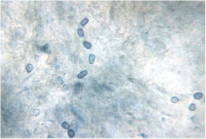 Characteristic barrel-shaped arthroconidia of Coccidioides species, the infectious spores of the mycelial phase. This 3–5μm arthroconidia are easily dispersed in soil and air and inhaled into the deeper airways of the lungs. Fungal culture of the mycelial phase carries a high risk of biological contamination. BSL-3 practices, containment equipment, and facilities are recommended for propagating and manipulating sporulating cultures of these species and for processing soil or other environmental materials known to contain infectious arthroconidia. Lactophenol cotton blue stain. Photo courtesy of Dr. Lisa F. Shubitz. Valley Fever Center for Excellence. The University of Arizona. Tucson, USA.