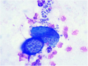 Cytology of a sample from a dog with coccidioidomycosis showing spherules containing numerous endoconidia. These endoconidia can remain in the lung tissue or disseminate to multiple body sites. Diff-Quik stain. Photo courtesy of Dr. Lisa F. Shubitz. Valley Fever Center for Excellence. The University of Arizona. Tucson, USA.