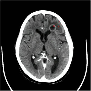Brain CT. Rounded and hypodense left-frontal lobe subcortical lesion with hyperdense contours that is associated with adjacent digitiform oedema measuring 17mm×15mm.