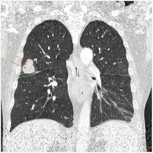 Lung CT. Multiple nodular, hypodense lesions with liquid content, defined outlines, thin walls and peripheral enhancement, in intimate contact with adjacent vascular structures, at the level of the posterior segment of the right upper lobe.