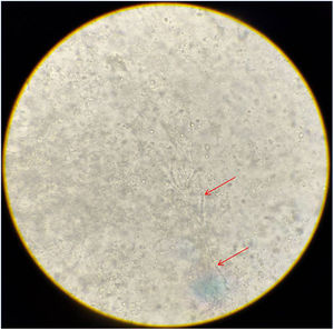 Direct examination of the contents of the cerebellar abscess. Fine, hyaline and septate hyphae are observed. Lactophenol blue stain, 400×.