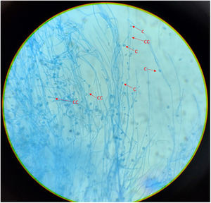 Microculture of the isolation obtained. Thin, hyaline, septate filaments are observed, with undifferentiated conidiogenous cells from which single smooth-walled conidia emerge, subspherical to elongated in shape. Lactophenol blue stain, 400×. CC: undifferentiated conidiogenous cell; C: conidium.