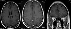 Cortes axial y coronal de cerebro. Se observan lesiones nodulares hipointensas en T1 a nivel fronto-parietal y parieto-occipital, subcorticales que refuerzan con contraste y con marcado edema perilesional.