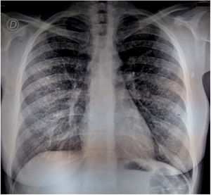 Radiografía de tórax con patrón miliar tras 50 días de tratamiento con antibióticos tuberculostáticos.