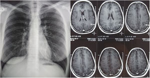 Radiografía de tórax y RMN de cerebro con contraste. No se observan lesiones patológicas tras 14 meses del inicio de los síntomas.