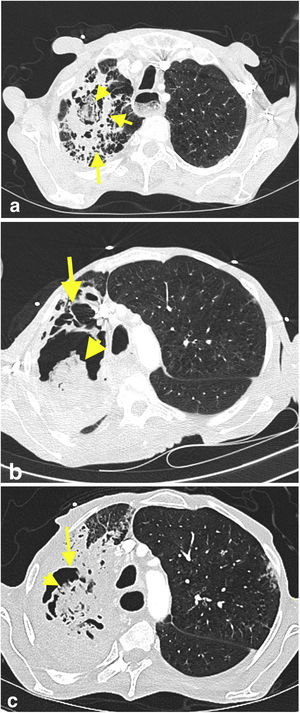 Axial chest CT image obtained in patient's first visit to ER (a) shows a cavitary lesion (short arrow) that contains an oval-shaped opacity (arrowhead) in the upper lobe of the right lung. The cavitary lesion is surrounded by a thick wall and parenchymal consolidation (long arrow). Axial CT images of the patient obtained three weeks (b) and five weeks (c) after the first chest CT reveal progressive increase in size of the cavitary lesion (arrows), as well as its content with solid-like appearance (arrowheads). The consolidation around the cavitary lesion also progressed in the right upper lobe. CT findings were suggestive of fungus-ball in a cavity with surrounding consolidation.