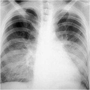 Chest X-ray showing the interstitial pattern and the inflammation involving air space, and peribronchial and perivascular interstitial spaces. Furthermore, there is interstitial nodular damage with interlobular septum thickening and loss of contour.