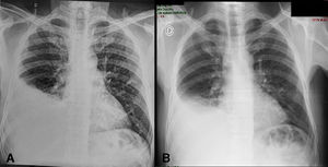 A y B) Radiografías de tórax frontal que evidencian radioopacidad en la base del pulmón derecho, compatible con derrame pleural. En la figura B se observa una ligera disminución de la radioopacidad, aunque persiste el derrame pleural.