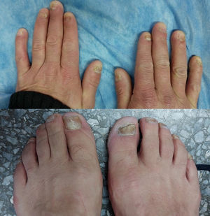 Onicomicosis distal subungueal en las 10 uñas de los pies, distrofia ungueal total en todas las uñas de las manos y lesión proximal profunda en el índice derecho.