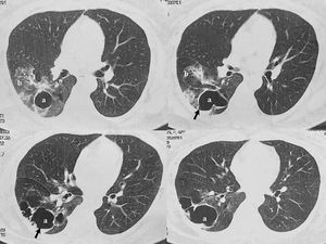 Computed tomography scan of the thorax. (a) Cavitary lesion (40×71mm) with a small air-hydro level  associated with (b) bronchiectasis was observed in the right lower lobe of the lung on admission.