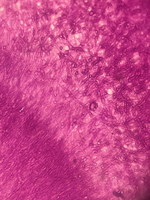 Septate hyphae with an irregular branching pattern grouped into a compact mass. Periodic acid-Schiff stain, magnification 40×.