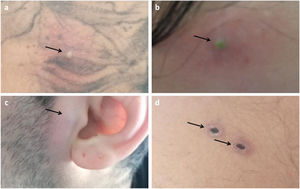 (a) Acneiform pustular lesion on the back. (b) Acneiform pustular lesion on the forehead. (c) Papular lesion progressing to a pustule with subsequent central crust formation in the preauricular region. (d) Evolved lesions exhibiting central crusting on the abdomen.