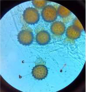 Lactophenol cotton blue wet mount of clinical R. homothallicus strain (a, non-septate hyphae; b, zygospore and c, uneven suspensor cell) isolated from rhino-orbital sample of a female patient diagnosed with COVID-19 and mucormycosis, hospitalized at Institute of Medical Sciences, Banaras Hindu University, Varanasi, India. The image was captured using bright-field binocular compound light microscope (Olympus) at 400×.
