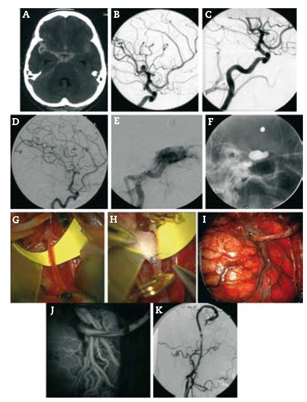 Bypass surgery for the prevention of ischemic stroke, current ...