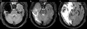 66-year-old man with resected glioblastoma. Hyperintense fluid in the resection cavity in the same follow-up study that demonstrates progression. Follow-up axial FLAIR sequences: (a) at 12 months after surgery, the fluid in the cavity is isointense compared to normal CSF, (b) at 15 months, the fluid becomes hyperintense, and extensive high-signal areas in the posterior part of the cavity are observed and enhance after contrast administration (not shown), consistent with tumour progression, (c) at 18 months, the fluid remains hyperintense and the tumour progresses. CSF-cerebro-spinal fluid.